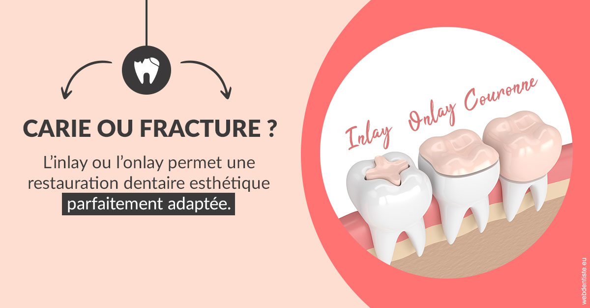 https://selarl-docteur-gilles-garnier.chirurgiens-dentistes.fr/T2 2023 - Carie ou fracture 2