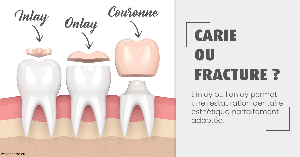 https://selarl-docteur-gilles-garnier.chirurgiens-dentistes.fr/T2 2023 - Carie ou fracture 1