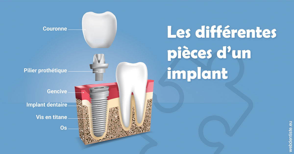 https://selarl-docteur-gilles-garnier.chirurgiens-dentistes.fr/Les différentes pièces d’un implant 1